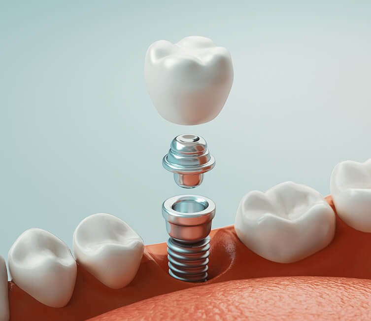 illustration of a dental implant