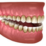 gingivitis, gum disease, periodontal disease, periodontitis, bad breath, dentist in granbury, what causes gum disease