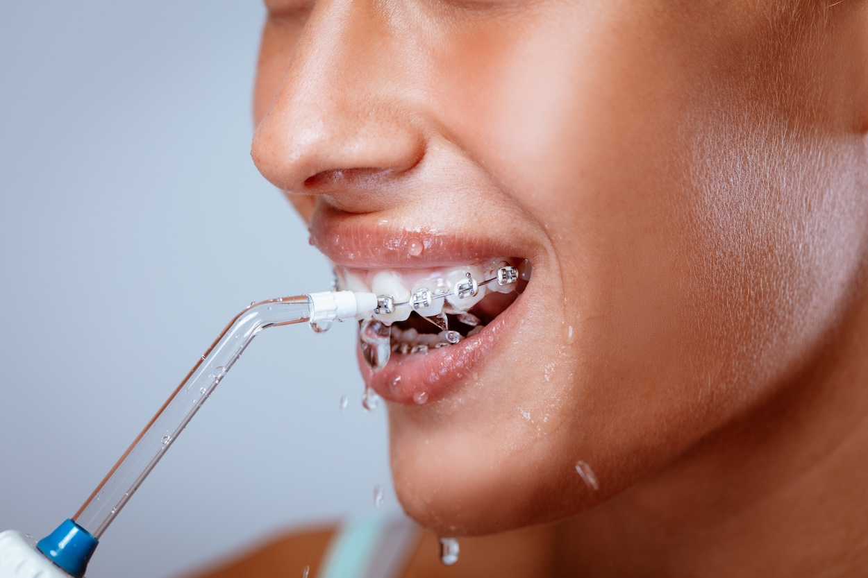 oral hygiene with braces, braces care, dental tips for braces, Granbury Park Dental, Dr. Paul Froude, Granbury TX dentist, orthodontic care, healthy gums with braces, flossing with braces, brushing with braces