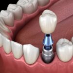 dental implants, Granbury Park Dental, Granbury dentist, Dr. Paul Froude, dental care, tooth replacement, oral health, implant-supported dentures, implant-supported bridges, dental hygiene