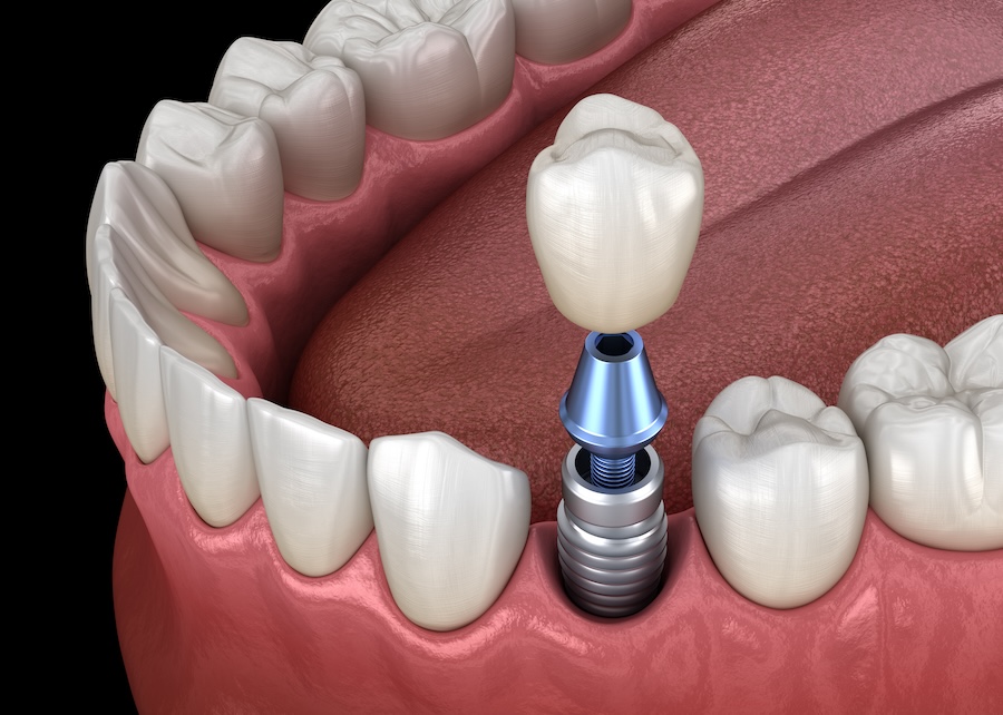 dental implants, Granbury Park Dental, Granbury dentist, Dr. Paul Froude, dental care, tooth replacement, oral health, implant-supported dentures, implant-supported bridges, dental hygiene