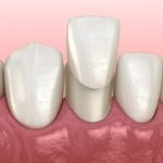 dental veneers, porcelain veneers, cosmetic dentistry, veneer process, Granbury TX, tooth imperfections, smile makeover