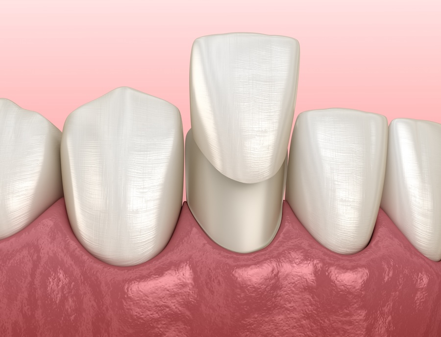 dental veneers, porcelain veneers, cosmetic dentistry, veneer process, Granbury TX, tooth imperfections, smile makeover