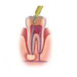 root canal therapy, dentist in Granbury, Granbury root canal, dental therapy, endodontic treatment