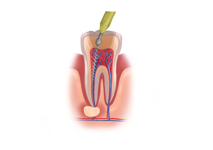 root canal therapy, dentist in Granbury, Granbury root canal, dental therapy, endodontic treatment