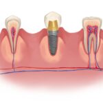 how long dental implants last, dental implants lifespan, Granbury Park Dental, Dr. Paul Froude, Granbury TX dentist