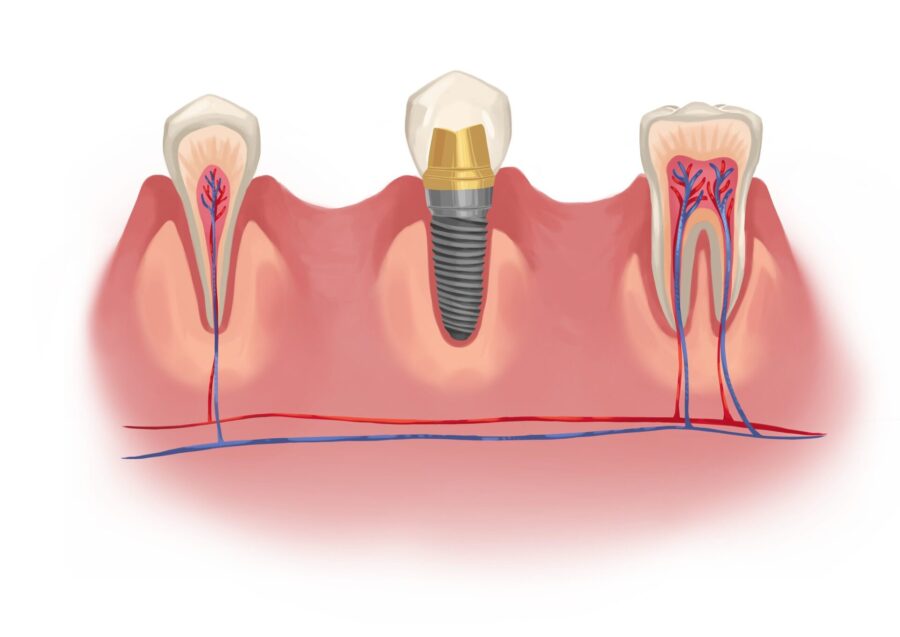 how long dental implants last, dental implants lifespan, Granbury Park Dental, Dr. Paul Froude, Granbury TX dentist