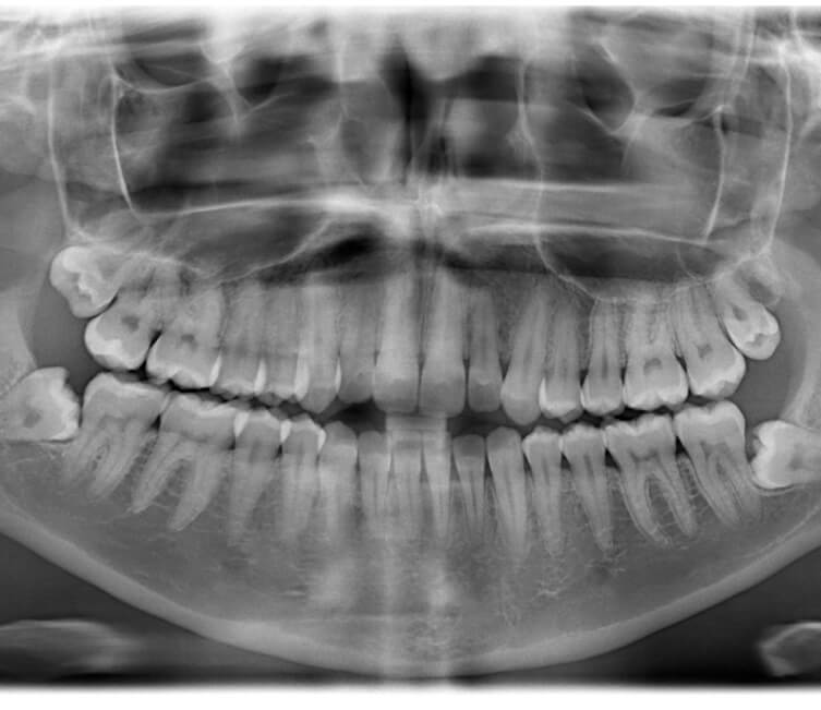 X-ray of mouth with impacted wisdom teeth