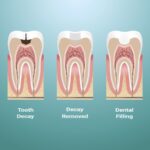 dental filling process