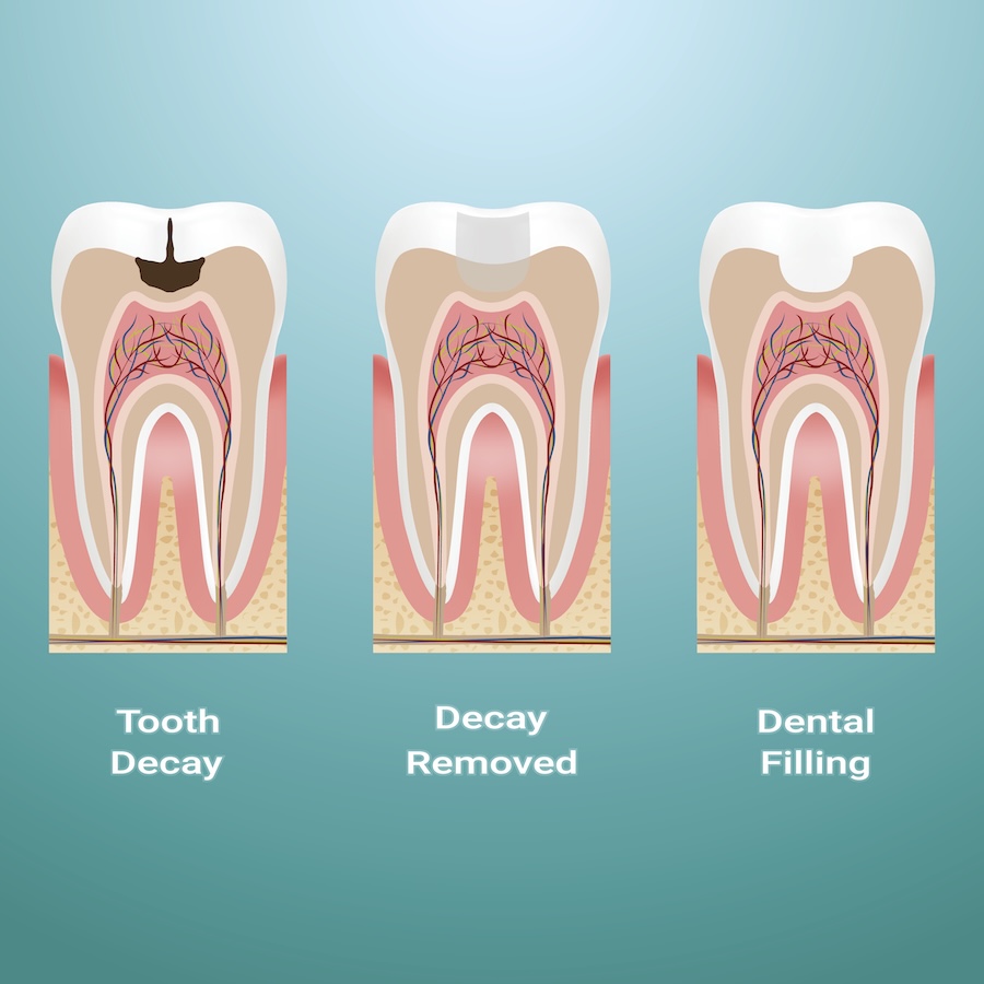 dental filling process