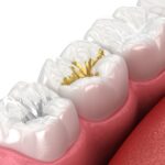 types of dental fillings on molar teeth
