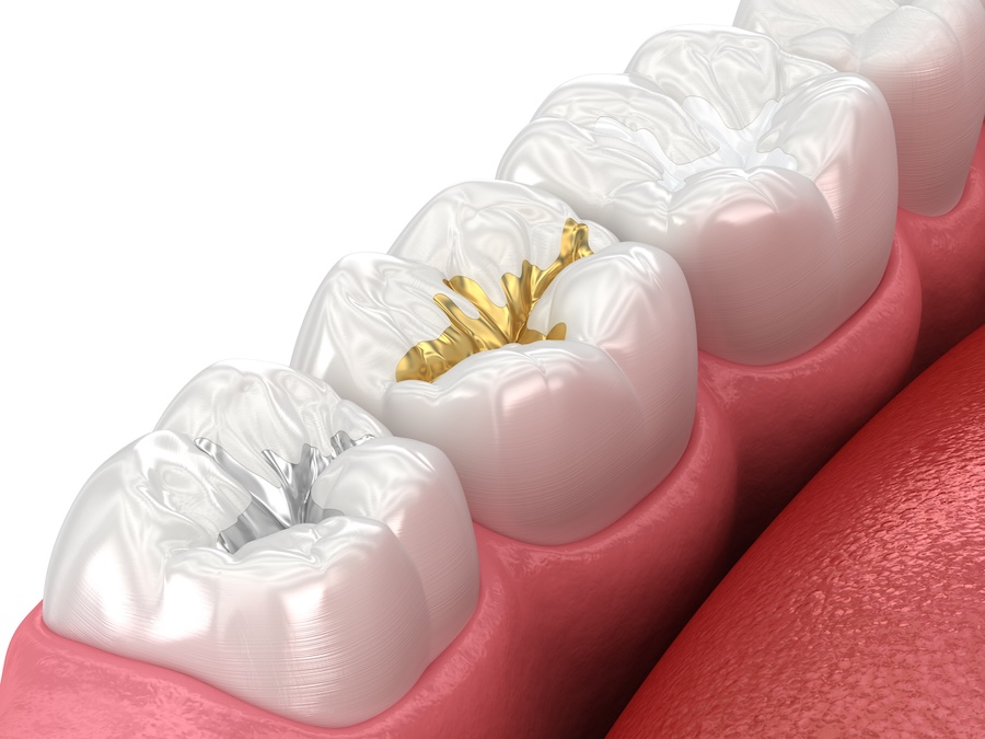 types of dental fillings on molar teeth