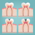 dental crown vs dental filling for dental decay and cavities