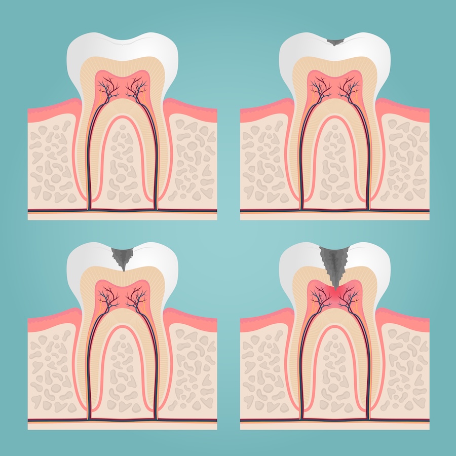 dental crown vs dental filling for dental decay and cavities